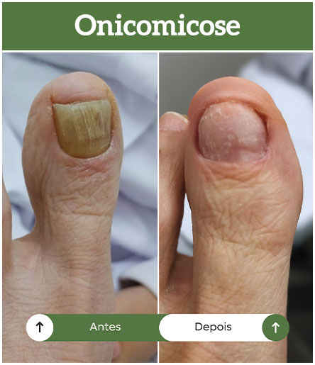 antes-depois-onicomicose-all-pe-sorocaba-clinica-podologia