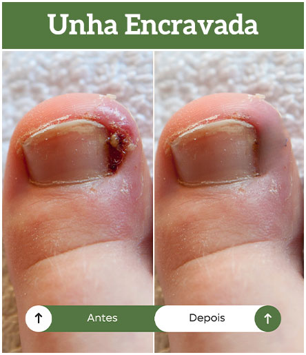 antes-depois-unha-encravada-all-pe-sorocaba-clinica-podologia