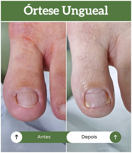orteses-ungueais-all-pe-sorocaba-clinica-podologia